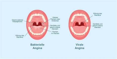 angina oder halsschmerzen