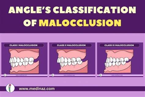 Angle's Classification Of Malocclusion
