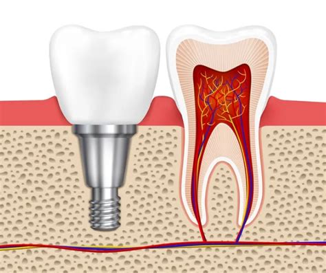 ankara implant öneri 