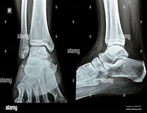 Ankle Ap Lat