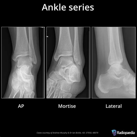 Ankle Ap View
