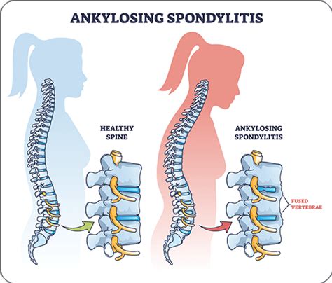 ankylosing spondylitis Archives - Genetic Lifehacks