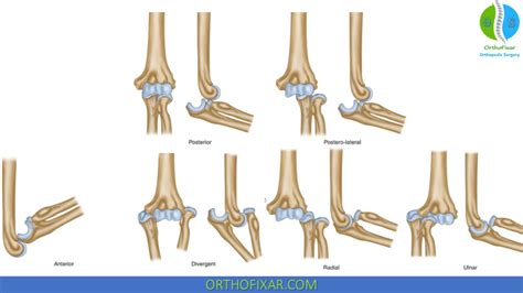 Anterior Dislocation Of Elbow
