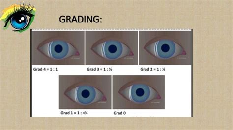 Anterior Eye Grading Best In 0 5 Steps Eyes Grade - Eyes Grade