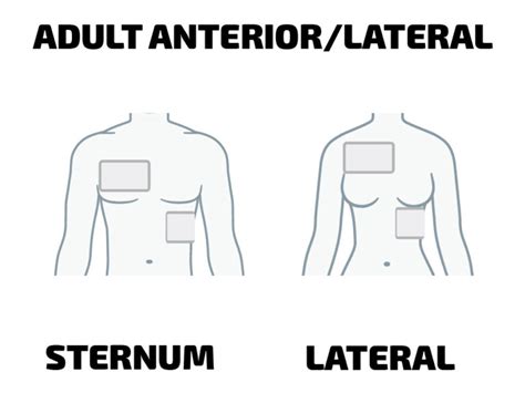 Anterolateral Aed Pad Placement