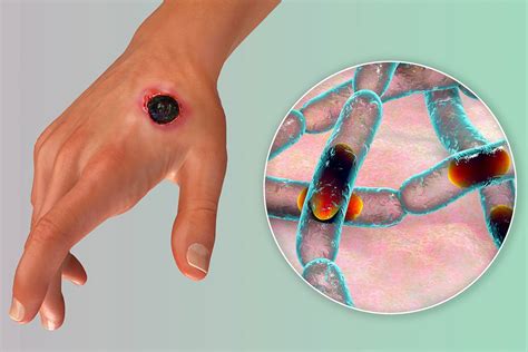 Anthrax Is An Example Of A Zoonotic Disease That