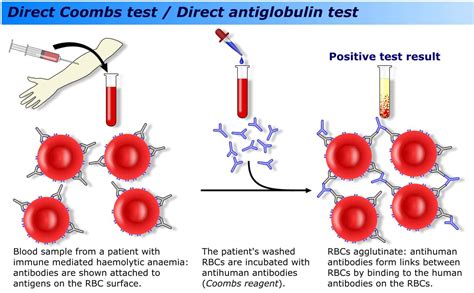 Antiglobulin Coombs Test