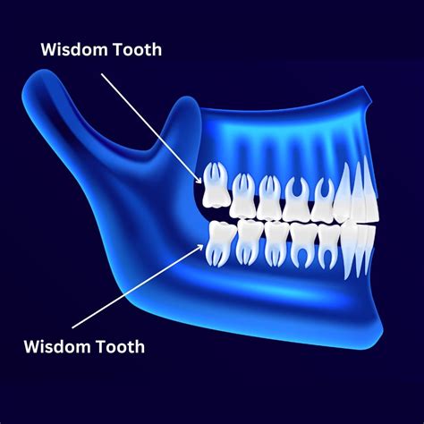 Any Of Your Wisdom Teeth Nyt