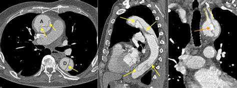 Aortic Dissection Ct