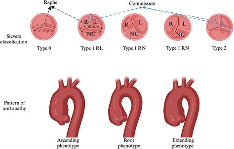 Aortopathy