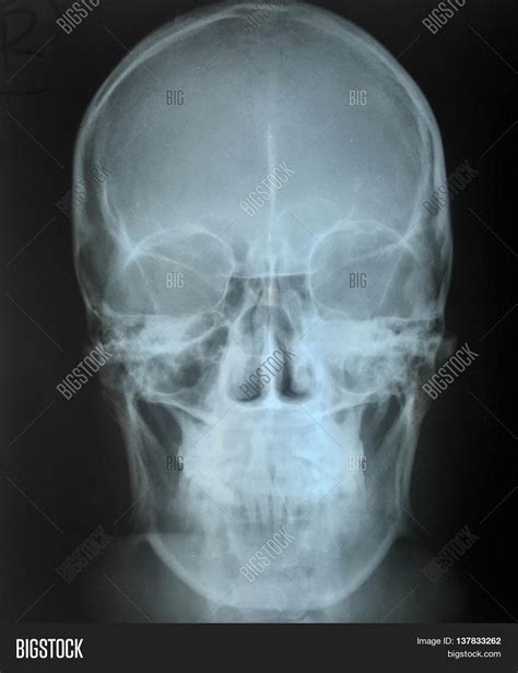 Ap View Of Skull