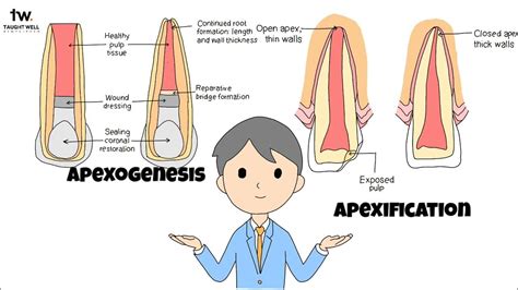 Apexogenesis Vs Apexification