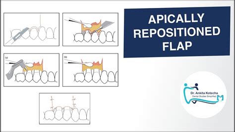 Apically Positioned Flap Continuing Dental Education