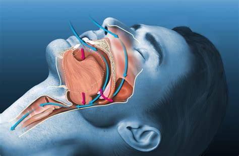 apnea