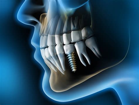 Appareil Dentaire En 3d   Imagerie Dentaire 3d Planmeca - Appareil Dentaire En 3d