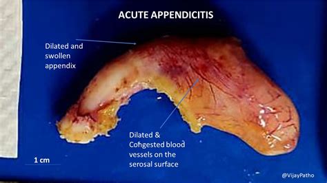 appendicitis kronis adalah