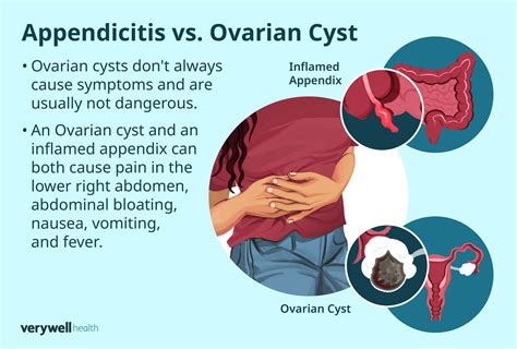 Appendix Versus Ovary Pain