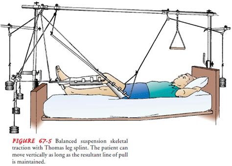 Application Balanced Skeletal Traction