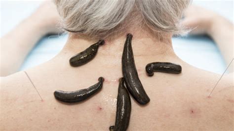 Application Of Leech Therapy And Khadir In Psoriasis By Dilip Kumar Verma 2013 07 06