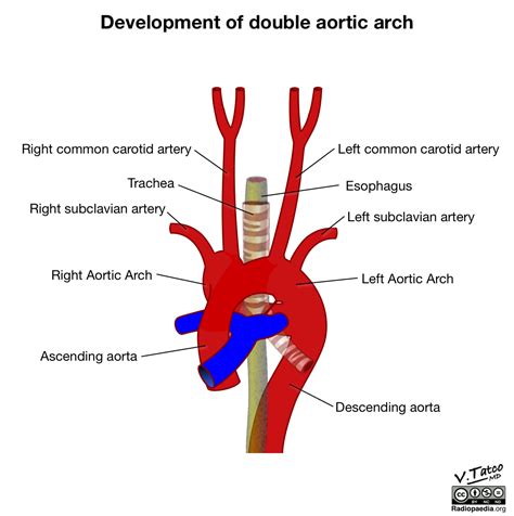 Arc Of Aorta