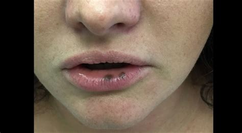 are thin lips a turn off virus exposure