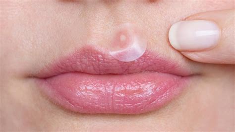 are thin lips attractive as acne cream
