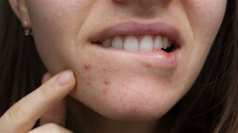 are thin lips attractive as acne skin problems