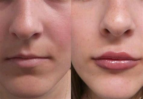 are thin lips attractive as acne treatment