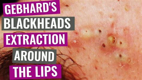 are thin lips attractive like blackheads removal