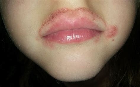 are thin lips attractive like skin rash