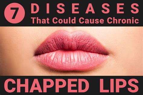 are thin lips bad for kissinger disease