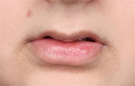 are thin lips dominant definition medical