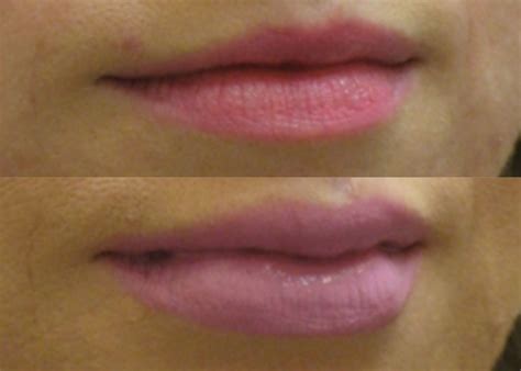 are thin lips dominant definition medical