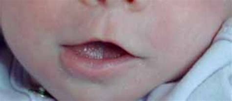 are thin lips genetic disease pictures