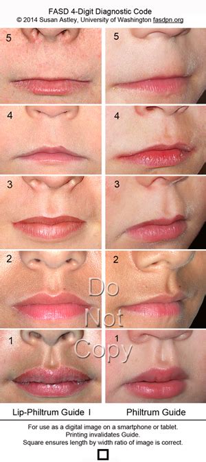 are thin lips genetic diseases caused