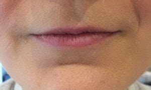 are thin lips genetic testing available