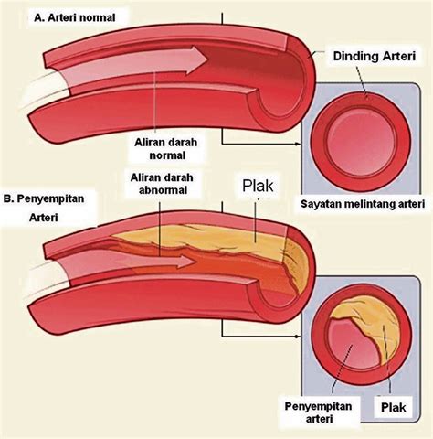 arteri