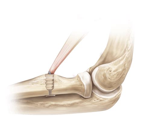 Arthrex Distal Biceps Button
