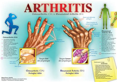 arthritis adalah