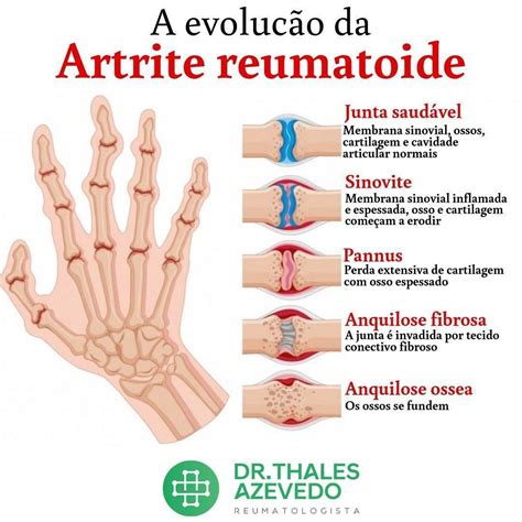 artrite reumatoide sintomas