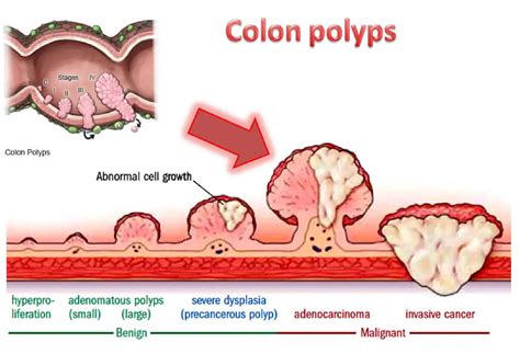 ascending colon single polyp