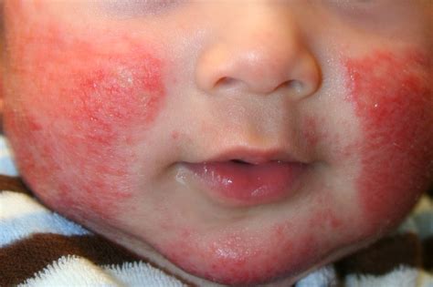 askep dermatitis pada anak