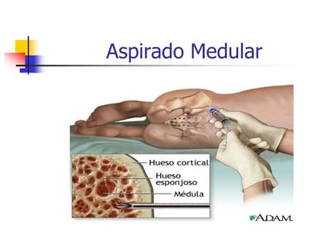 aspirado medular - English translation – Linguee