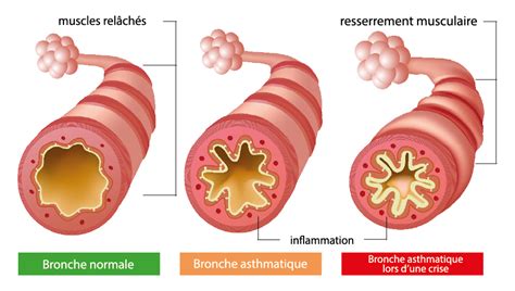 Asthme Bronchique