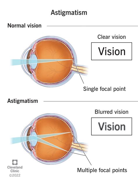 astigmatism orsak