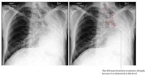 Atelectasis Icd 10