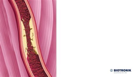 ateroskleros diagnos