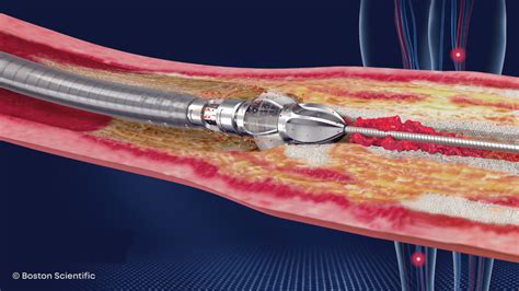 Atherectomy
