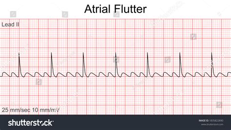 Atrial Flutter Fibrillation Ecg