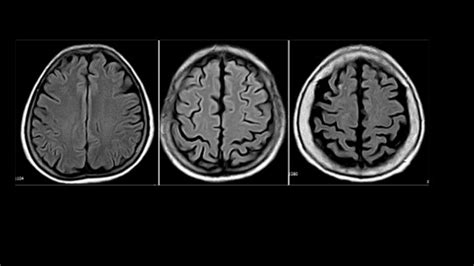 atrofia cortical frontal pdf